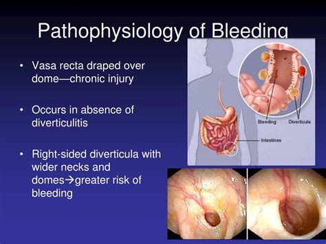 PPT - Diverticular Disease PowerPoint Presentation, free download - ID:4744596