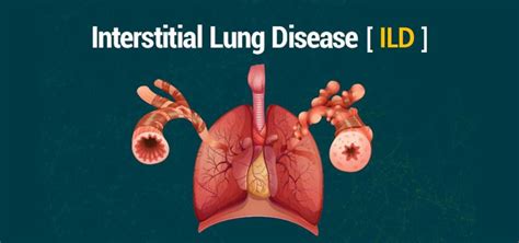 Interstitial Lung Disease (ILD) | RespiRehab Online Pulmonary Rehabilitation