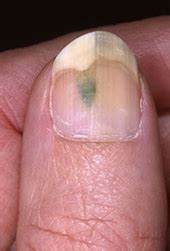 Green Nail Fungus: Symptoms, Causes and Treatment