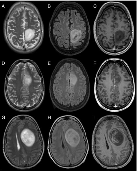 Adult-type gliomas: Astrocytoma, IDH-mutant. MRI of three different... | Download Scientific Diagram