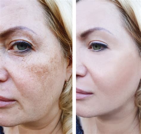 girl face wrinkles before and after, pigmentation - Anti-Age Naturally!