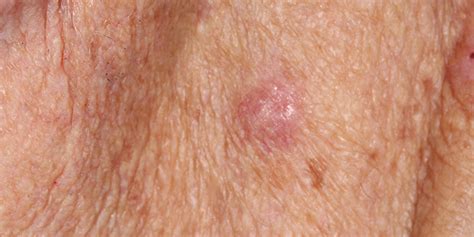 Atypical Fibroxanthoma – AFX | Skin Cancer And Reconstructive Surgery Center