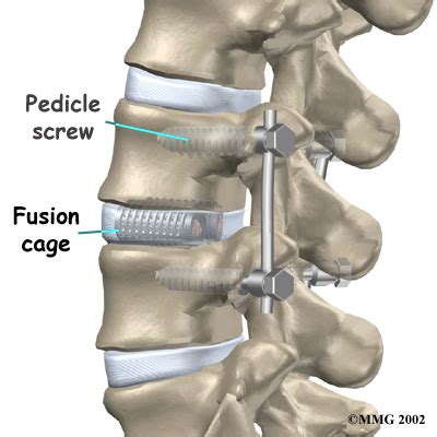 French surgeon performs world’s first spinal fusion surgery using 3D printed spine cages ...