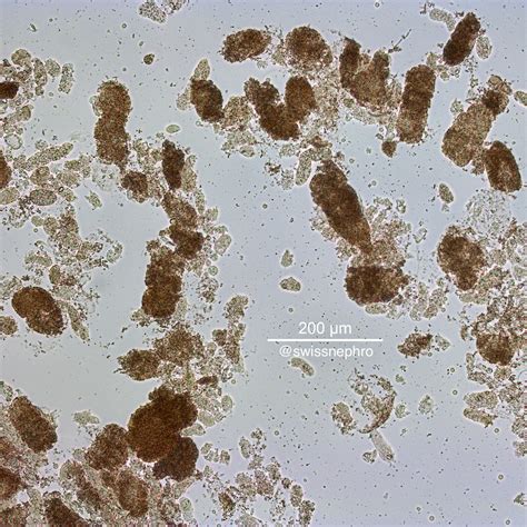 Urine Microscopy with Dr. Florian Buchkremer – GlomCon (pubs)