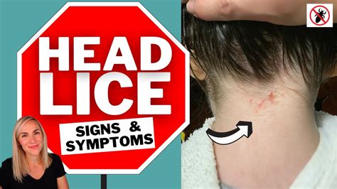 Lice Signs and Symptoms Video Tutorial - YouTube