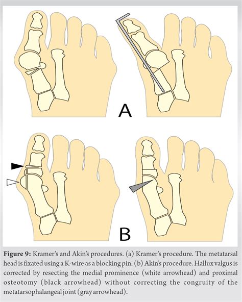 Distal Metatarsal and Proximal Phalangeal Osteotomies without Soft Tissue Procedure for Hallux ...