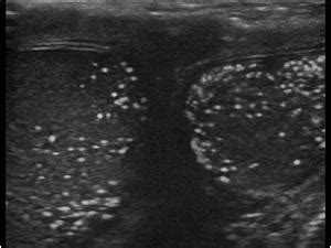 Urinary Tract and male reproductive system | 2.3 Scrotum : Case 2.3.13 Microlithiasis and ...