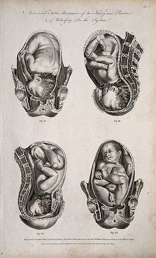 Four babies in different delivery positions in the womb free public domain image | Look and Learn