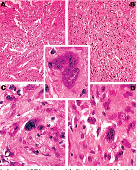 Table 2 from Atypical fibrous histiocytoma and atypical fibroxanthoma: presentation of two cases ...