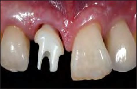 Placement of the custom zirconia abutment. Note the optimal emergence... | Download Scientific ...