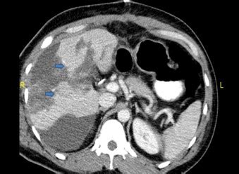 CT scan showing grade 4 multiple liver lacerations | Download Scientific Diagram