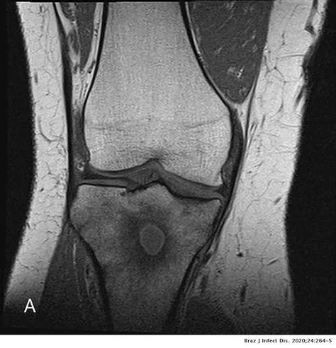 “Penumbra sign” of Brodie's abscess | The Brazilian Journal of Infectious Diseases