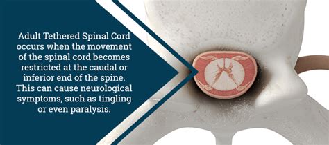 Do I Have Tethered Spinal Cord? | Jason E. Lowenstein, MD