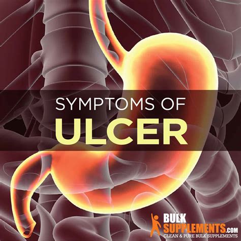 Ulcer: Symptoms, Causes & Treatment by James Denlinger