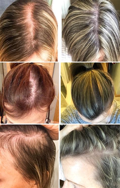 Women And Hair Loss: Causes, Solutions, and Support — First Thyme Mom