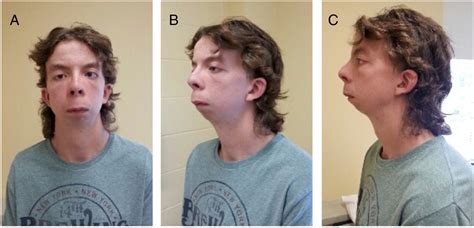 [PDF] Are Patients With Loeys-Dietz Syndrome Misdiagnosed With Beals ...