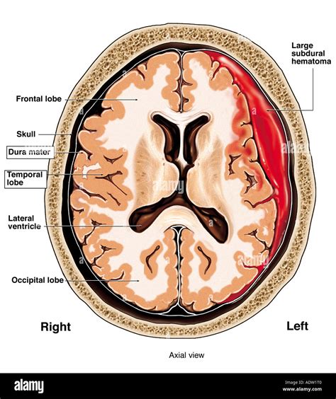 Subdural Hematoma Symptoms