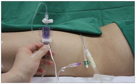 Intraoperative measuring of intra-abdominal pressure through urinary... | Download Scientific ...