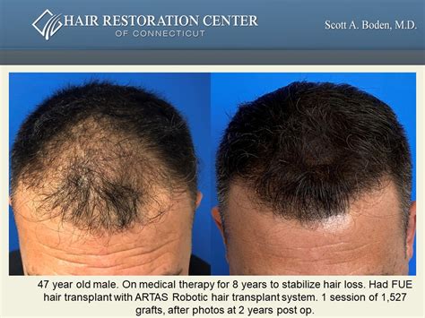 FUE - ARTAS Robotic Hair Transplant Case Study - Hair Restoration Center of CT | FUE Hair Transplant