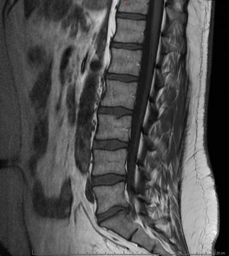 Just got MRI Scan images (waiting for report) : r/Sciatica