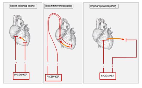 Anatomy of the temporary pacemaker circuit (2022)