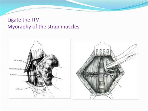 PPT - SUBTOTAL THYROIDECTOMY PowerPoint Presentation, free download - ID:2761031