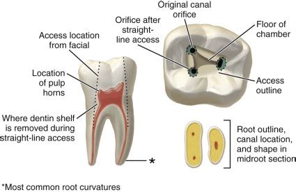 Pulpal anatomy and access preparations | Pocket Dentistry