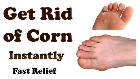 Corn Removal - Home Remedies for corns on toes - How to Get rid of corn - YouTube