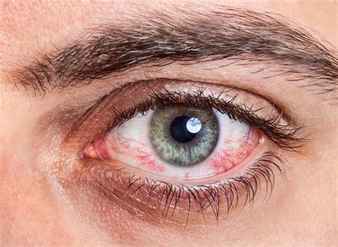 Eye Allergy (Allergic Conjunctivitis) | Allergies and Health