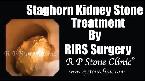 Staghorn Kidney Stone Treatment by RIRS Surgery - YouTube