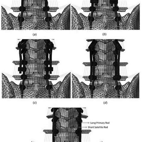 PSO surgeries: (a) PSO 1 primary rods, (b) PSO 1 medial satellite rods,... | Download Scientific ...