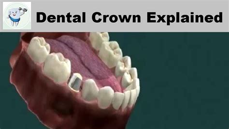 Types of Dental Crowns | Dental Crown Explained - Dental Clinic