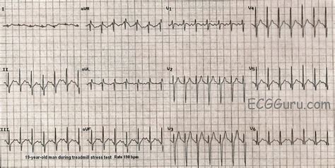 Junctional Tachycardia Vs Svt - Merryheyn