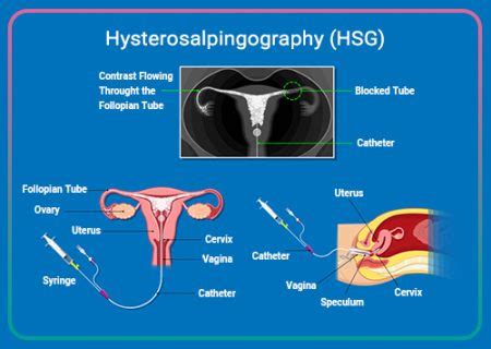 What is hysterosalpingography (HSG)? | HSG procedure | HayatMedTour