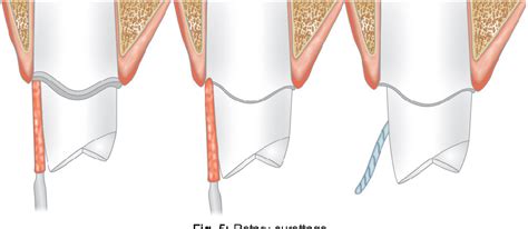 Figure 5 from Recent Advances : Gingival Retraction and Fluid Control | Semantic Scholar