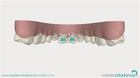 Invisalign Bite Ramps - Master Ortodoncia Invisible - Dr. Manuel RomanMaster Ortodoncia ...