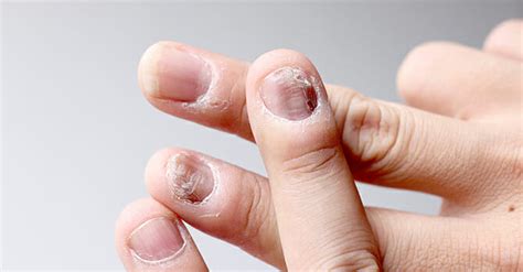 What You Need to Know About Psoriatic Nail Disease