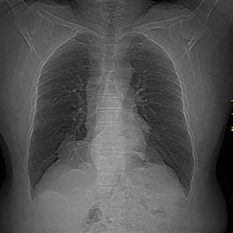 Can A Ct Scan Miss A Hiatal Hernia - antidotetips