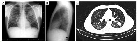 Radiology of a simple aspergilloma. (A) PA chest x-ray; (B) Lateral... | Download Scientific Diagram