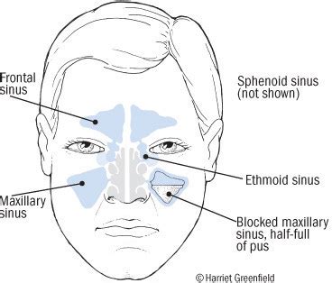 Acute Sinusitis - Harvard Health