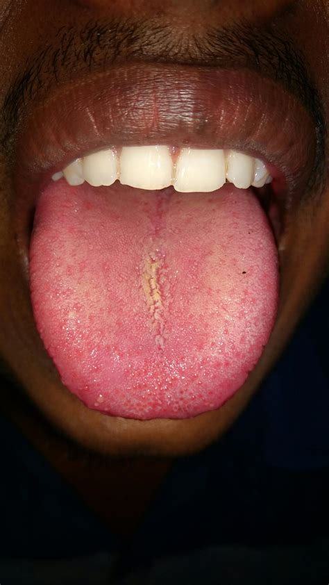 Multiple small painful ulcers in oral cavity with slightly coated