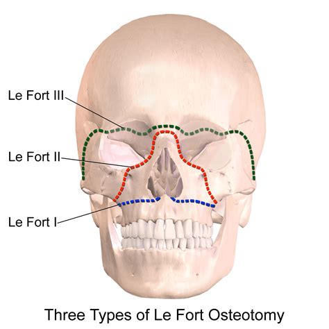 emDOCs.net – Emergency Medicine EducationLe Fort Fractures - emDOCs.net - Emergency Medicine ...