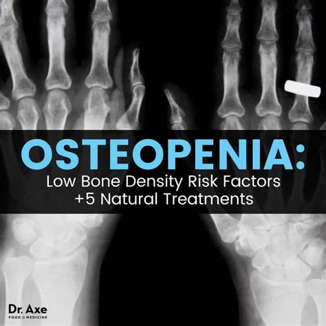 Osteopenia Risk Factors + 5 Natural Treatments - Dr. Axe