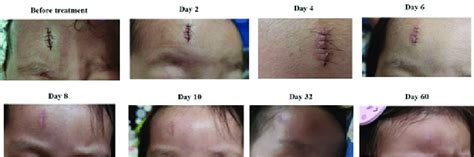 Treatment of a puncture wound with EP. The forehead of a local toddler... | Download Scientific ...