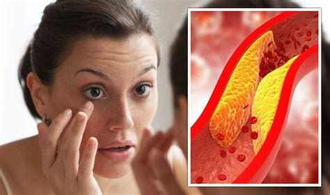 High cholesterol symptoms include xanthelasma - yellow deposits around the eyes | Express.co.uk