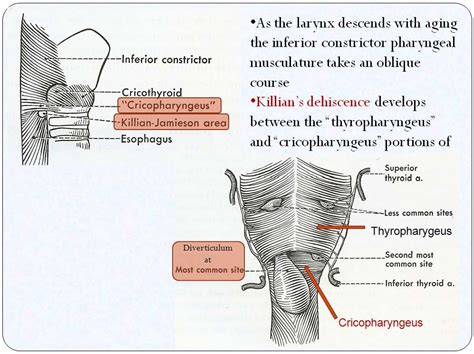 Zenker's Diverticulum | UCLA Head and Neck Surgery, ENT Ear, Nose & Throat Specialists, Los ...