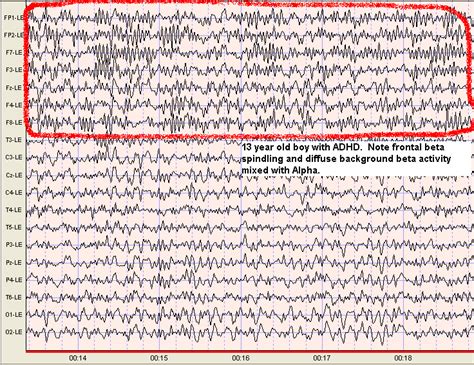 Beta Waves - Scottsdale Neurofeedback Institute, AZ