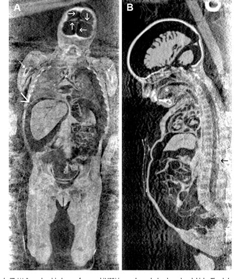 Figure 3 from Multidetector CT investigation of the mummy of Rosalia ...