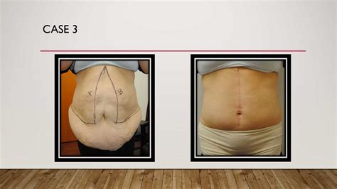 Tummy Tuck (Abdominoplasty) Before and After Photos - Dr Anzarut Plastic Surgery