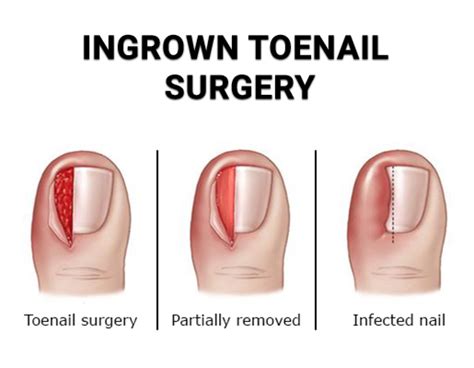 Ingrown toenail nail bed: Ingrown Toenail – OrthoInfo – AAOS